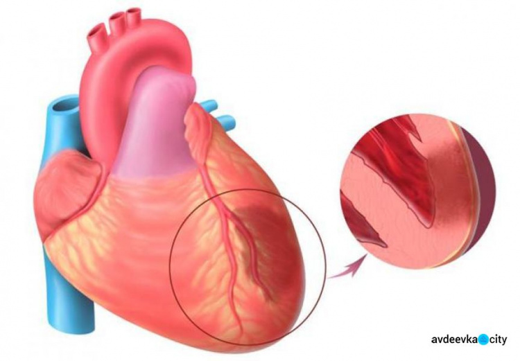 В Авдеевке выше областного показатель заболеваемости инфарктом миокарда