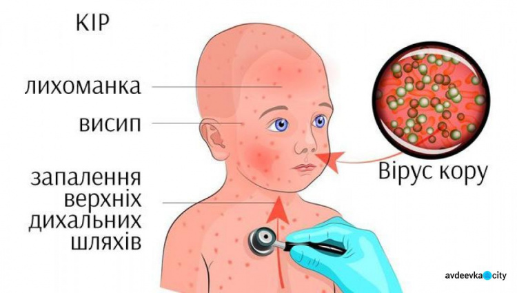 В Украине повысился риск вспышки кори